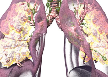 Longarts waarschuwt: “Dít moet iedereen weten over pulmonale hypertensie!”