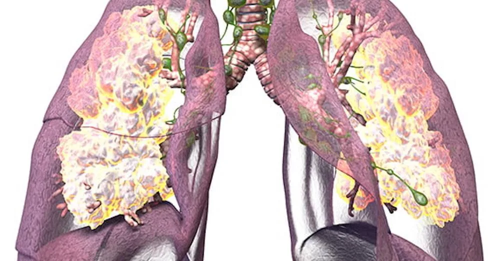 Longarts waarschuwt: “Dít moet iedereen weten over pulmonale hypertensie!”