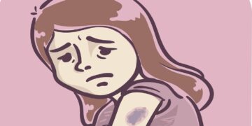 Opgelet! Hierom heb je sneller blauwe plekken als je ouder bent