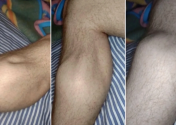 Krampen in kuiten en tenen tijdens het slapen? Dit is hoe je er snel weer vanaf komt