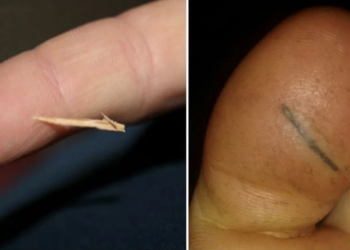 Moeder heeft geweldige manier om vervelende splinters te verwijderen; eenvoudig en snel!