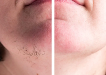 Dames opgelet! Daarom krijg je als je ouder bent vaker haren op je kin