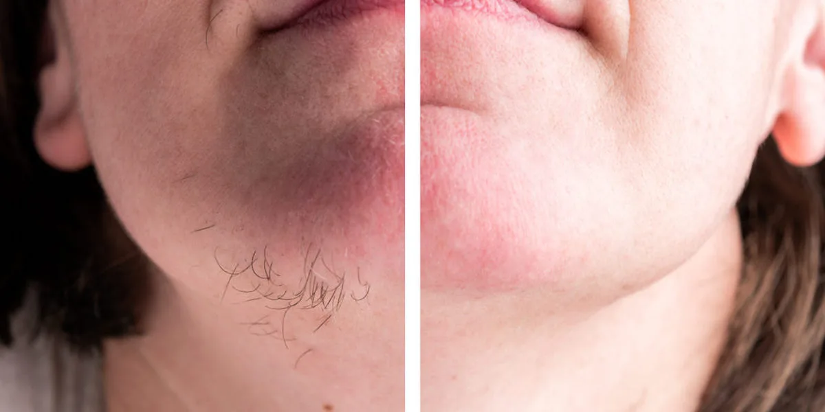 Dames opgelet! Daarom krijg je als je ouder bent vaker haren op je kin