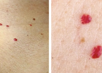 Last van kleine rode puntjes op je huid? Dit kunnen ze betekenen