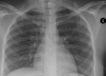 Houd je longen gezond: 8 tips om ze te reinigen (veel mensen weten dit niet)