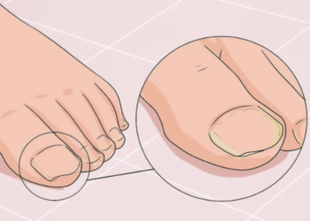 Je kunt voorgoed afrekenen met kalknagels. Dit middel is alles wat je nodig hebt