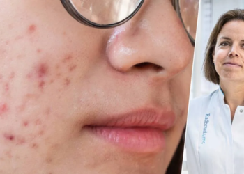 Dermatologen waarschuwen: deze voedingsmiddelen eten wij niet! (en ik nu ook niet meer)