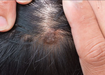 Ontdek de verrassende reden achter jouw hoofdhuidproblemen!