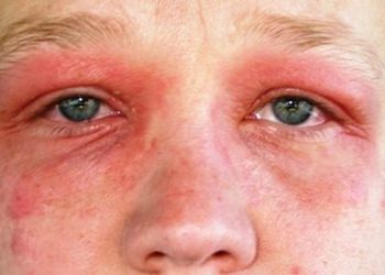 Tip van de eeuw: Deze 5 drankjes verminderen hooikoortsklachen direct