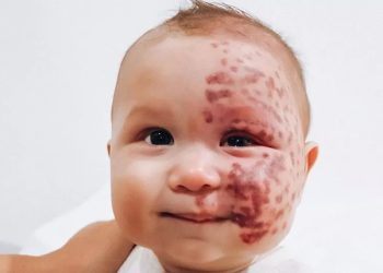 Moedervlek van baby weggelaserd: moeder krijgt zware kritiek (wat vind jij?)