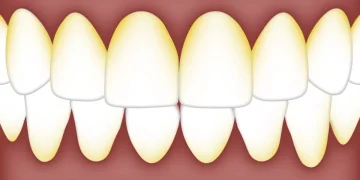 Tandartsen leggen uit: eet deze dingen niet om gele tanden te vermijden