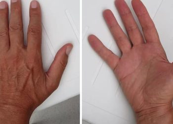 LET OP: Zien je handen er zo uit? Bel dan direct de dokter!