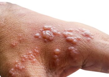 WHO roept noodtoestand uit vanwege nieuwe, gevaarlijke variant van het apenpokkenvirus