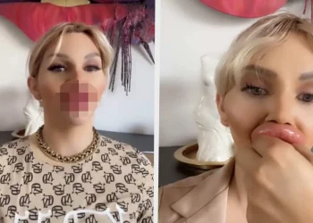 Vienna heeft XL-lip fillers maar klaagt nu dat ze niet goed kan eten en drinken