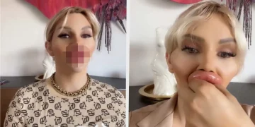 Vienna heeft XL-lip fillers maar klaagt nu dat ze niet goed kan eten en drinken