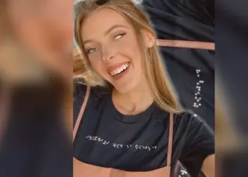 Chelsea (22) deelt haar ervaring met een zeldzame aandoening: “Dagelijks krijg ik opmerkingen over mijn gezicht”