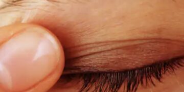 Af en toe last van een trillend ooglid? Oogarts legt uit over de oorzaak en oplossing