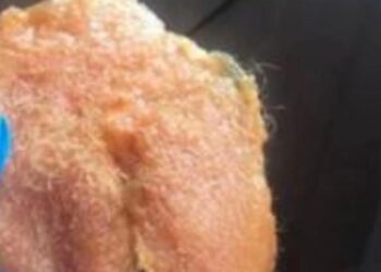 Jelke:” Ik moest naar het ziekenhuis door de bikiniwax”