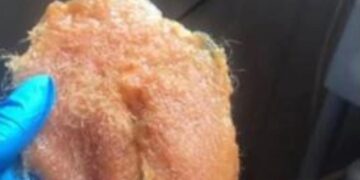 Jelke:” Ik moest naar het ziekenhuis door de bikiniwax”