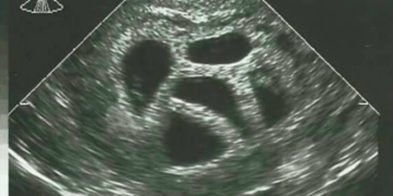 Jonge moeder weigerde een abortus van vijfling en laat een bijzondere foto zien van 20 jaar later. Wauw!