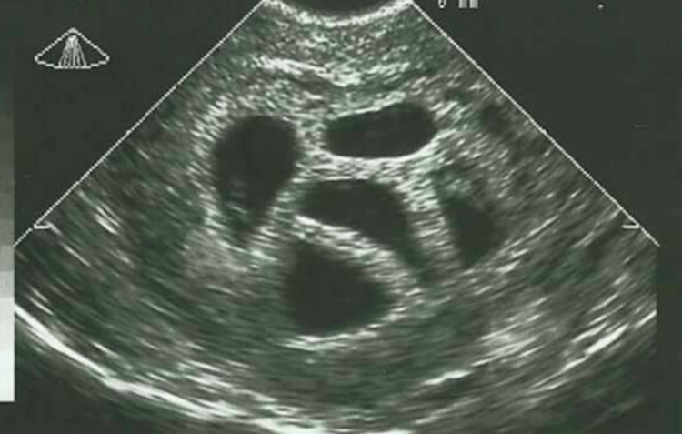 Jonge moeder weigerde een abortus van vijfling en laat een bijzondere foto zien van 20 jaar later. Wauw!