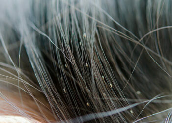 “Mijn vrouw vond dit in het haar van onze kindje. Moeten we ons nu zorgen gaan maken”