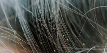 “Mijn vrouw vond dit in het haar van onze kindje. Moeten we ons nu zorgen gaan maken”