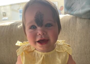 Ouders beschermen en verbergen dochter met moedervlek 2 jaar lang: “Nu is ze beeldschoon en gezond”