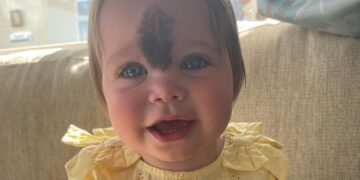 Ouders beschermen en verbergen dochter met moedervlek 2 jaar lang: “Nu is ze beeldschoon en gezond”