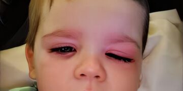 Opgepast! Moeder waarschuwt voor populair speelgoed dat haar zoontje bijna blind maakte