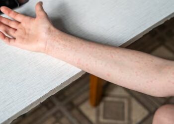 Mazelenuitbraak net voor carnaval: ‘Niet lekker, Thuisblijven!’