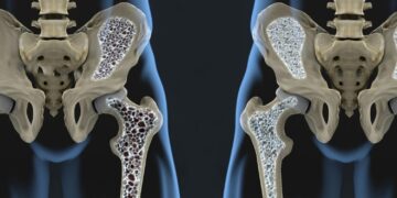 Dit zijn de belangrijkste oorzaken van osteoporose