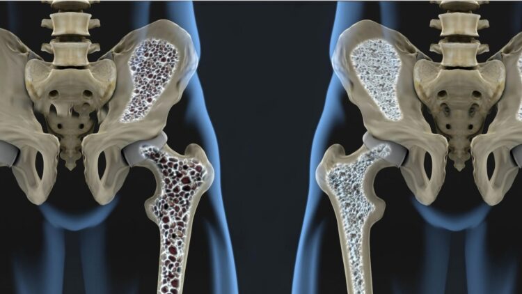 Dit zijn de belangrijkste oorzaken van osteoporose