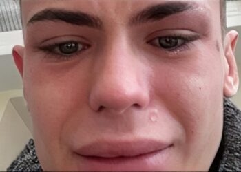 Jack (22) laat zijn gebit doen in Turkije en blijft verminkt achter