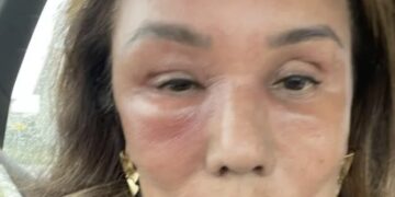 Grote zorgen om Patty Brard (70): met spoed naar het ziekenhuis, fans geschrokken van onheilspellende foto