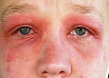 Heb jij hooikoorts? Haal deze plant vandaag dan nog uit jouw tuin!