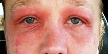 Heb jij hooikoorts? Haal deze plant vandaag dan nog uit jouw tuin!