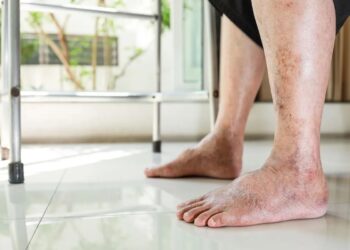 Dit zijn de eerste symptomen van een trombosebeen (en dit kun je doen om het te voorkomen)