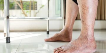 Dit zijn de eerste symptomen van een trombosebeen (en dit kun je doen om het te voorkomen)