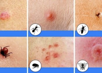 Bijt of steekt het? Zo herken je de insectenbeten (voor het te laat is)