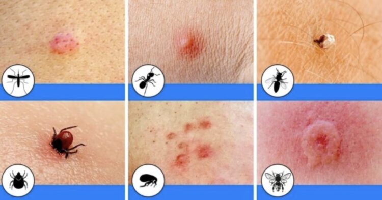 Bijt of steekt het? Zo herken je de insectenbeten (voor het te laat is)