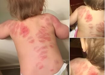 Moeder in shock na opvangdrama: Mijn dochter (1) is 25 keer gebeten op de opvang en niemand zei iets