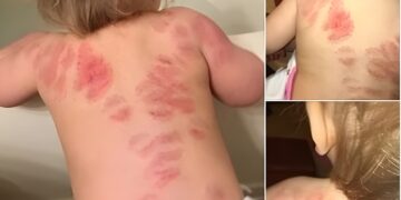 Moeder in shock na opvangdrama: Mijn dochter (1) is 25 keer gebeten op de opvang en niemand zei iets