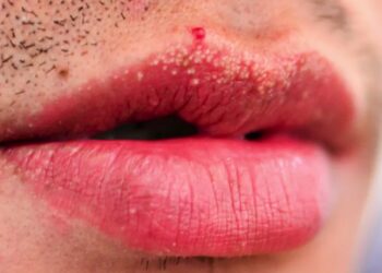 Arts geeft duidelijkheid: Dit is de reden achter vreemde witte bultjes op de edele delen