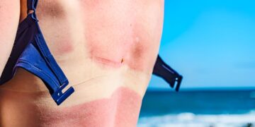 Consumentenbond waarschuwt: gebruik deze zonnebrandcrèmes niet – “Kans op huidkanker”