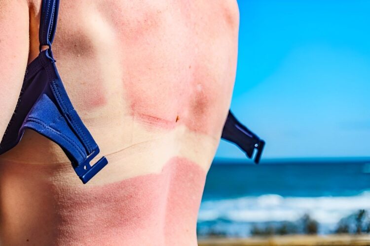Consumentenbond waarschuwt: gebruik deze zonnebrandcrèmes niet – “Kans op huidkanker”
