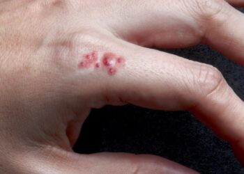 Artsen slaan alarm: steeds meer mensen besmet met MRSA verspreidt zich sneller dan verwacht