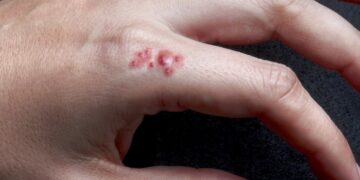 Artsen slaan alarm: steeds meer mensen besmet met MRSA verspreidt zich sneller dan verwacht