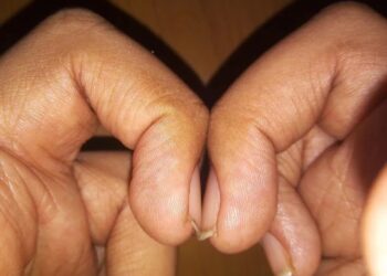 Deze simpele test met je vingers kan een verborgen gezondheidsprobleem onthullen