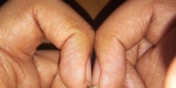 Deze simpele test met je vingers kan een verborgen gezondheidsprobleem onthullen